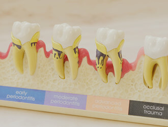 イメージ画像：歯周病治療